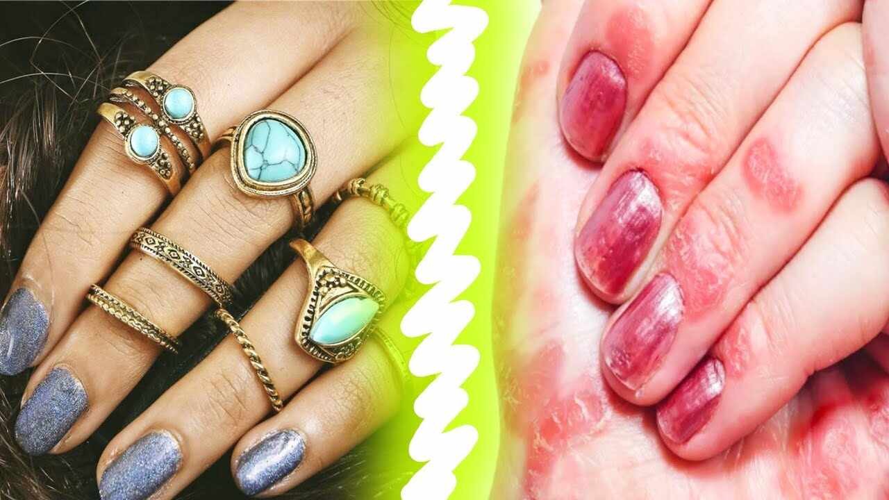 Simple Home Remedies To Prevent Skin Allergy From Artificial Jewellery