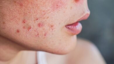 Hormonal Acne Warning Repeated Pimples on Same Spot May Signal Deeper Imbalance Doctors Explain