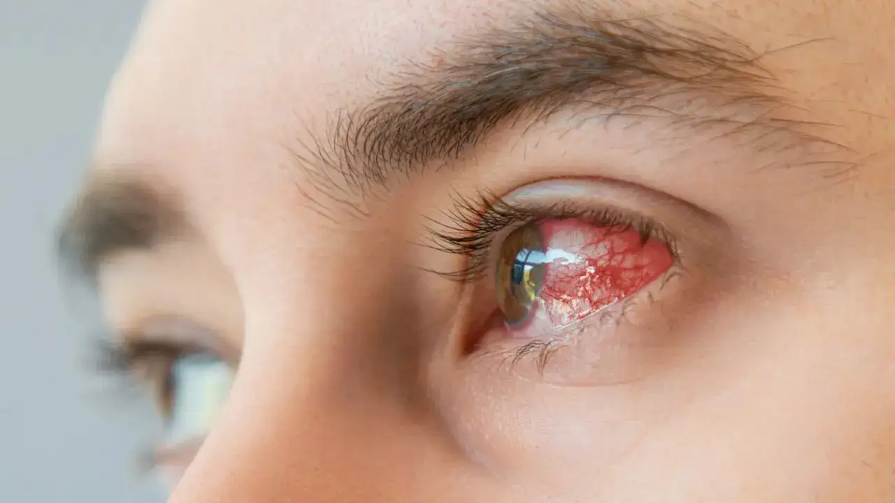 Contact Lens Mistake Causes Serious Eye Infection Doctors Warn Users to Stay Careful