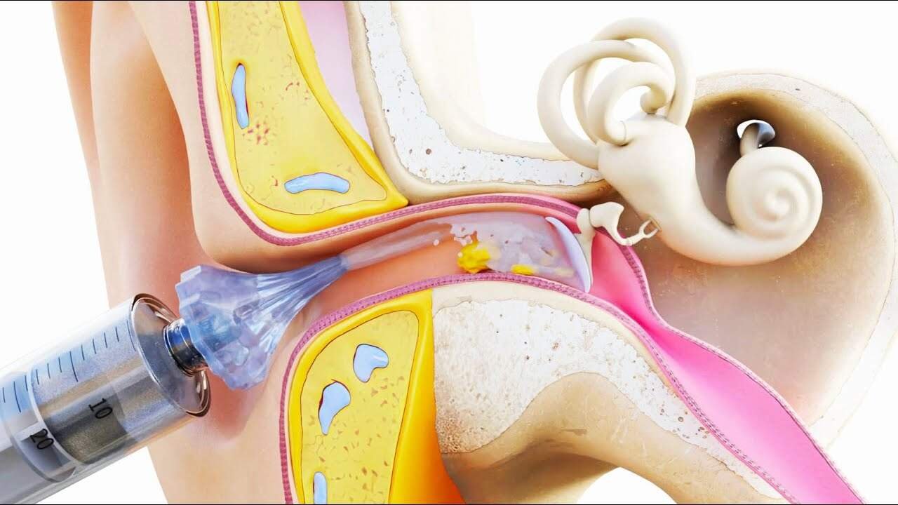 Water Stuck in Ear After Bathing Experts Warn Against Common Mistakes and Share Safe Remedies