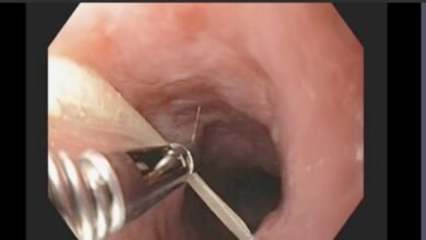 Fish Bone Stuck In Your Throat? Here Is What You Should Do Safely