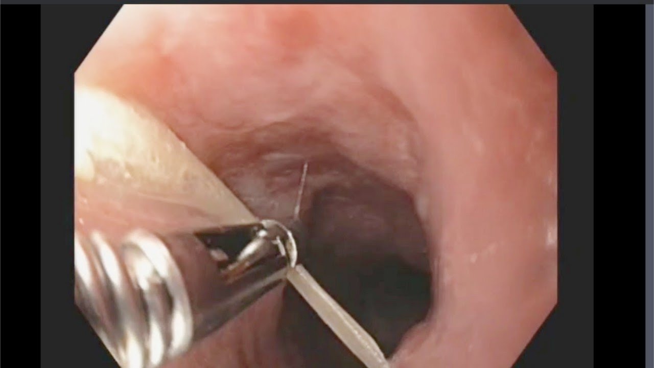 Fish Bone Stuck In Your Throat? Here Is What You Should Do Safely