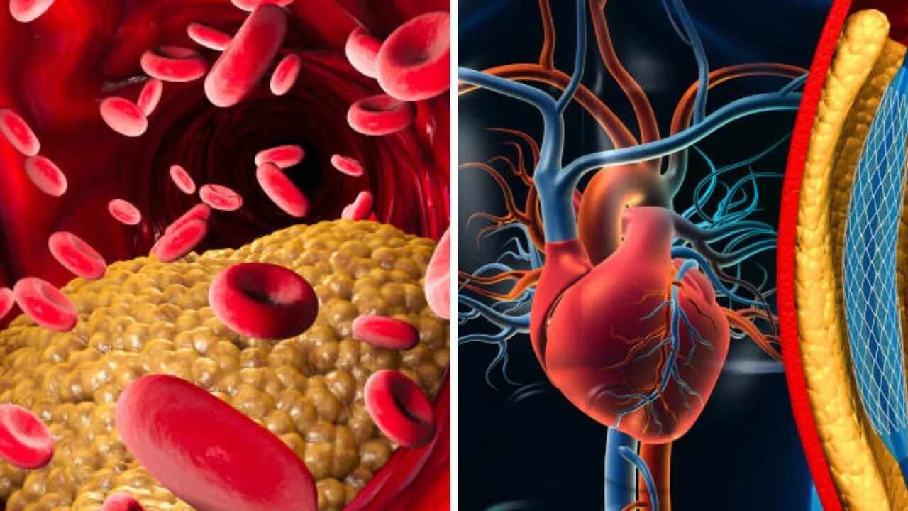 High Cholesterol Alert These Everyday Foods May Help Keep Bad Cholesterol in Check