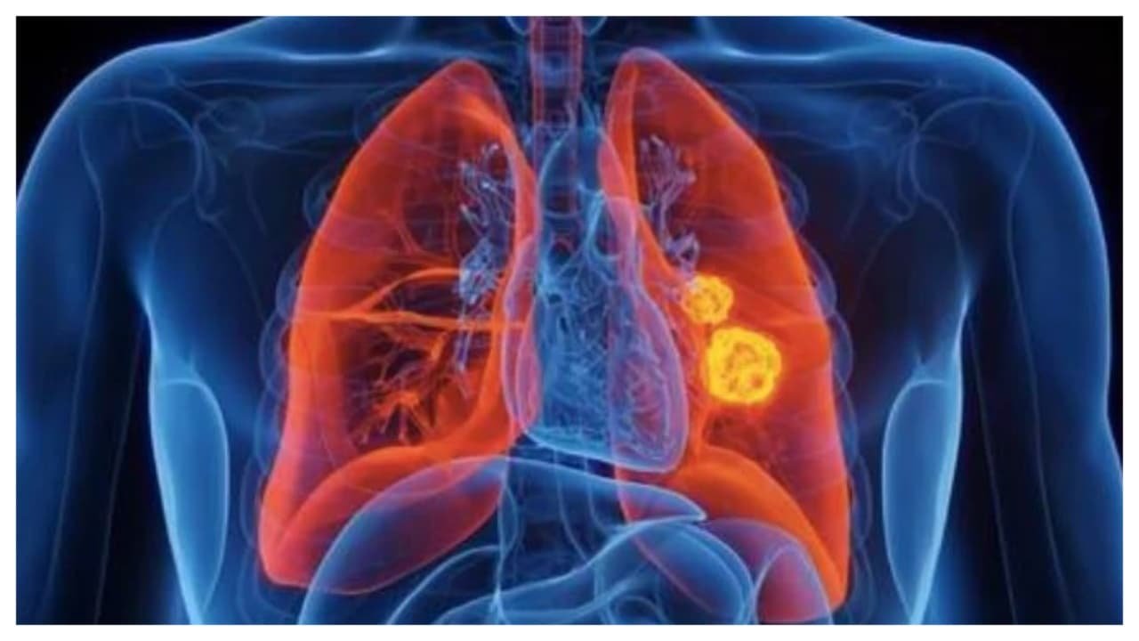 Unexpected Weight Loss And Loss Of Appetite Could Signal Serious Lung Health Issues