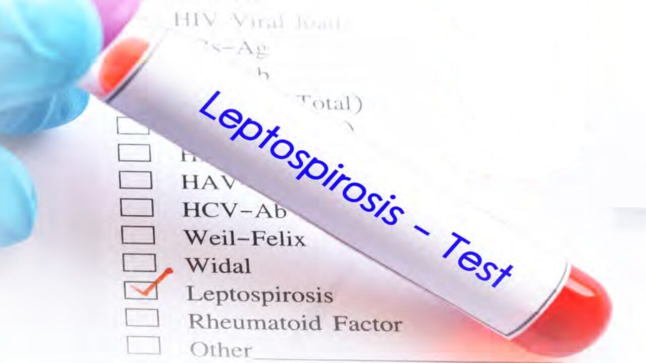 Telangana Leptospirosis Alert: Leptospirosis Cases Rise Sharply in Telangana During Monsoon